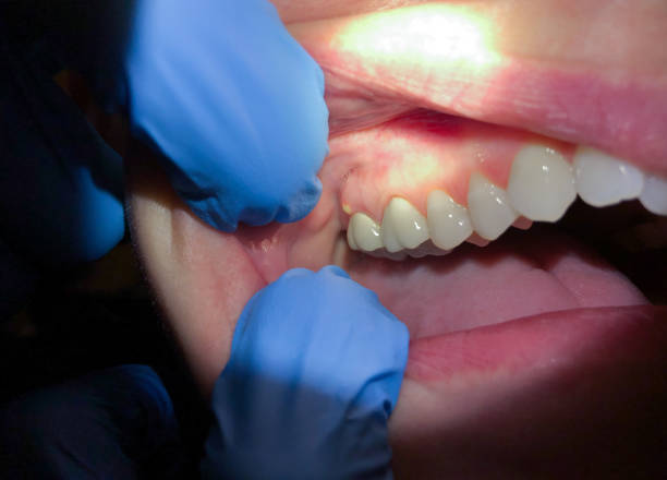 Best Emergency Treatment for Dental Infections or Abscesses in , RI